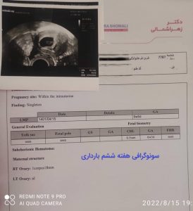 سونوگرافی هفته شش بارداری در ضخامت کم آندومتر و درمان با طب سوزنی دکتر انصاری